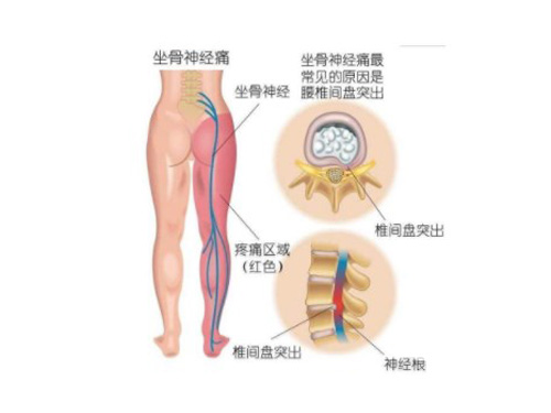 神经痛治疗